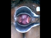 Preview 2 of Cervix dialator tool w/speculum