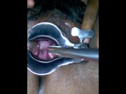 Preview 3 of Cervix dialator tool w/speculum