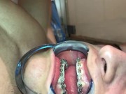 Preview 5 of Cuming on my own braces