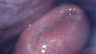 Endoscope cervix exploration (Camera inside vagina)