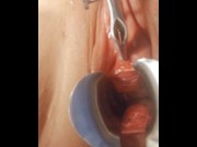 Preview 2 of Nasal Speculum in Urethra